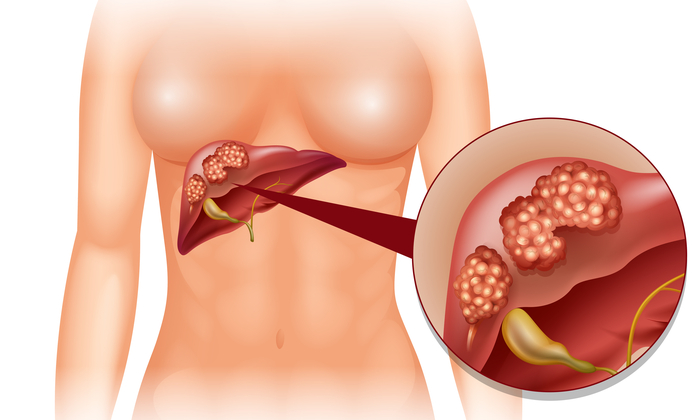 มะเร็งตับระยะสุดท้าย อาการ และการรักษา