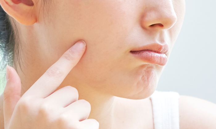 หน้าดำ สาเหตุและการดูแล