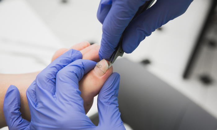 ถอดเล็บ ขั้นตอนการรักษาและการดูแล