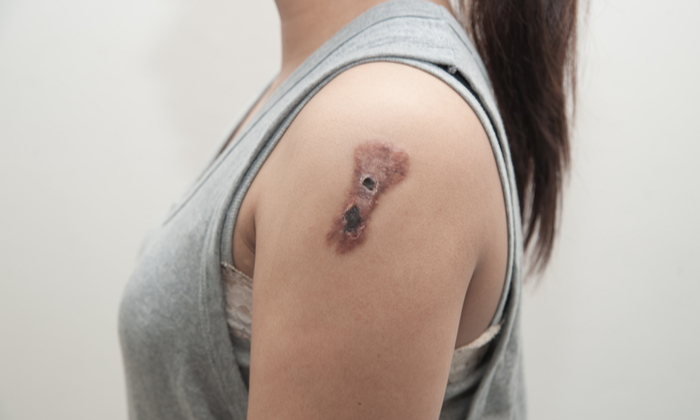 มะเร็งผิวหนัง