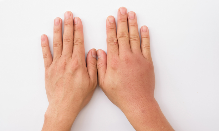 มือบวม อาการ สาเหตุ การรักษา