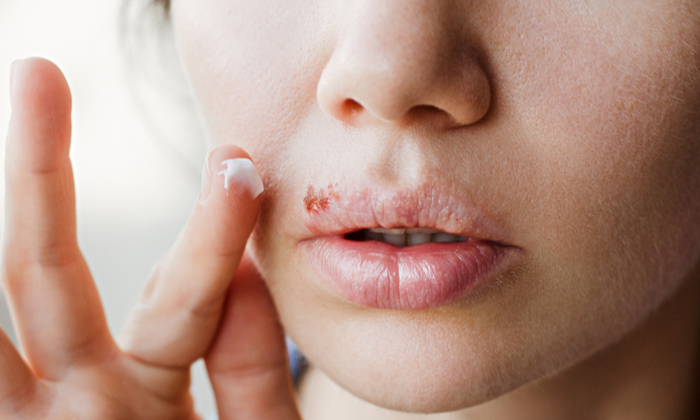รักษาเริมที่ปาก สามารถทำได้อย่างไร