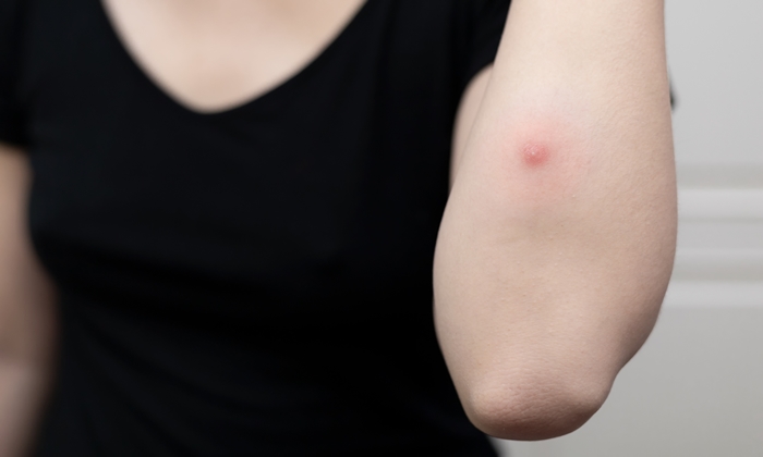 ฝี สาเหตุ อาการ และการรักษา