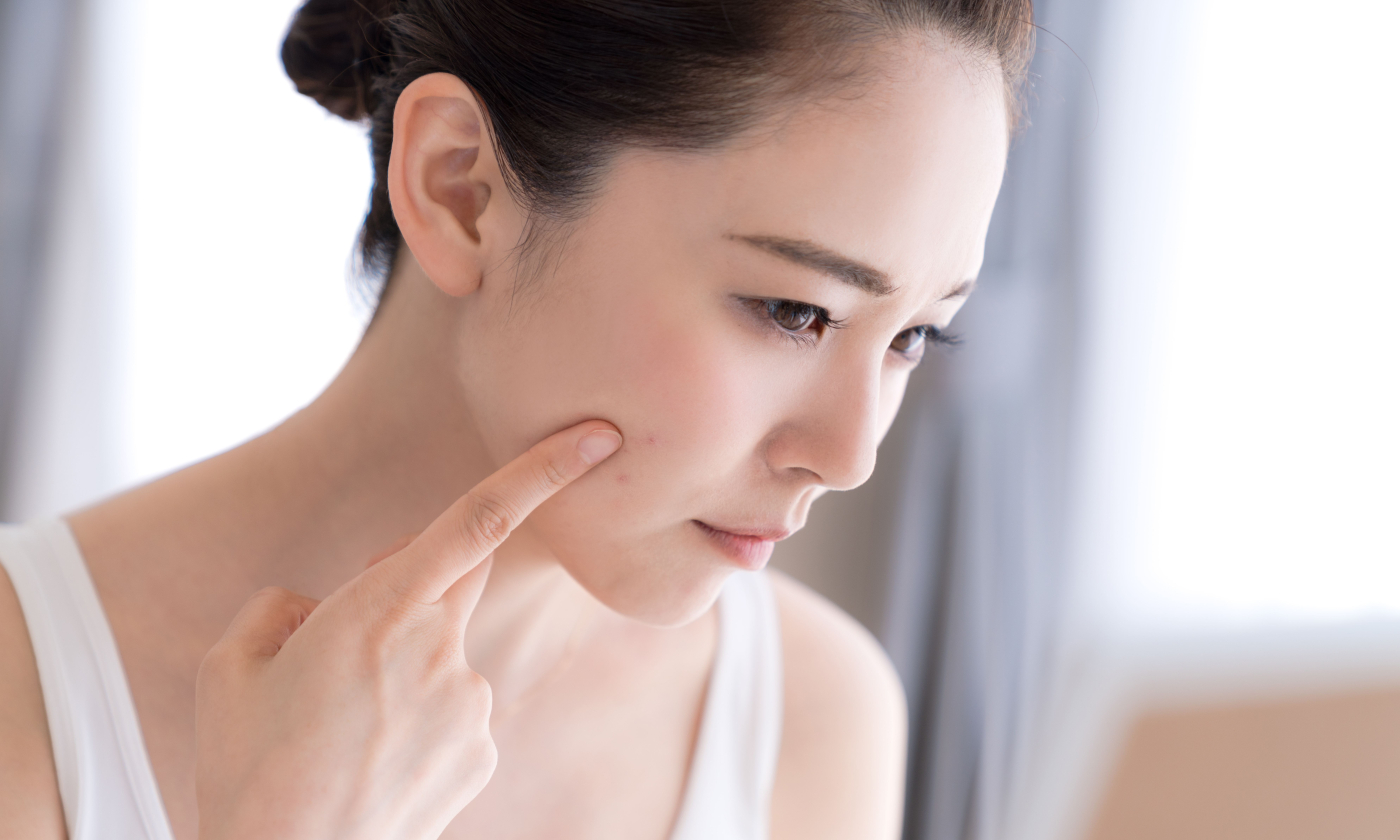 วิธีรักษาสิว ทำได้อย่างไรบ้าง