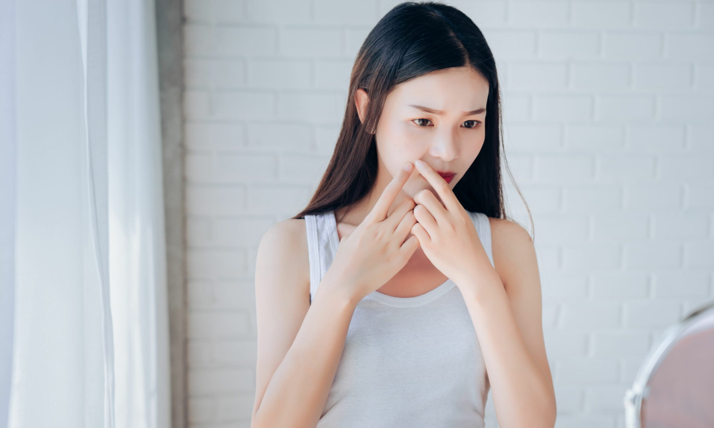 บีบสิว อย่างไรให้ถูกวิธี และข้อควรระวังในการบีบสิว