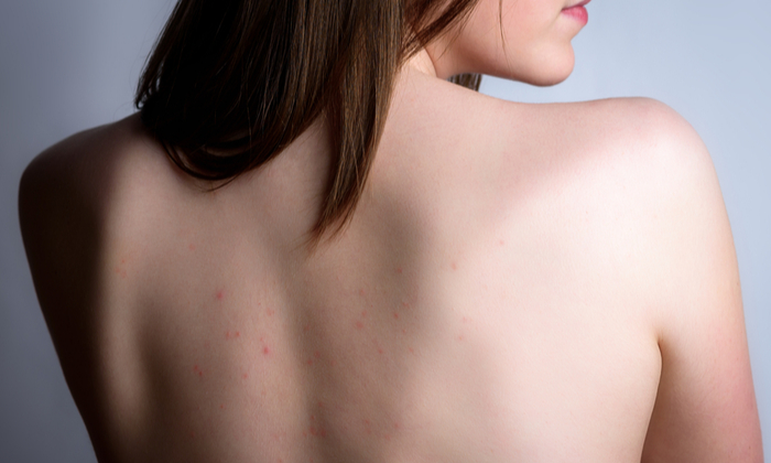 8 วิธี รักษาสิวที่หลัง