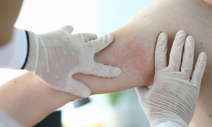 ตุ่มเอดส์ อาการเมื่อติดเชื้อเอชไอวี/เอดส์