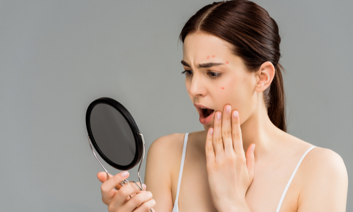 สิวเกิดจากอะไร