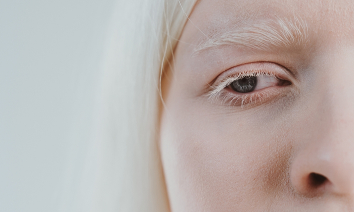 โรคผิวเผือก อาการ สาเหตุ การรักษา