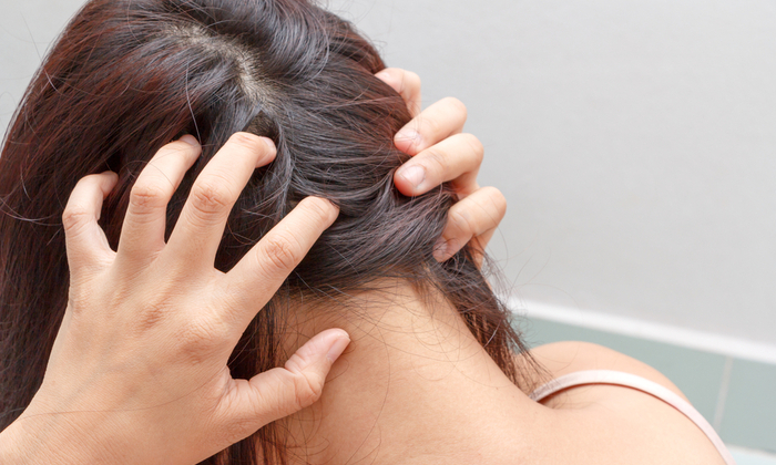 รังแคเกิดจาก อะไร มีวิธีรักษาอย่างไร