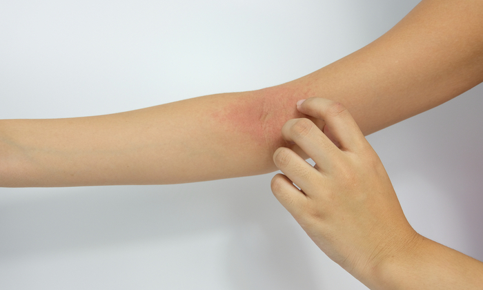 ผื่นลมพิษ สาเหตุ อาการ การรักษา