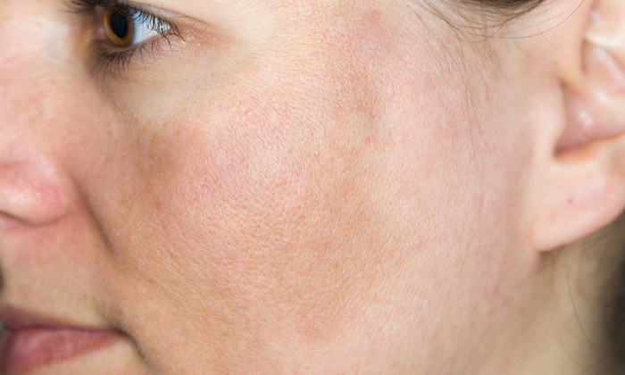 ฝ้า เกิดจากอะไร วิธีรักษาและป้องกันฝ้า