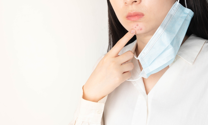 สิวหัวหนอง อาการ สาเหตุ การรักษา