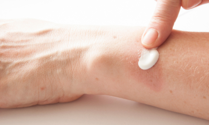 ยาทาเชื้อรา มีอะไรบ้าง และวิธีป้องกันผิวหนังติดเชื้อรา