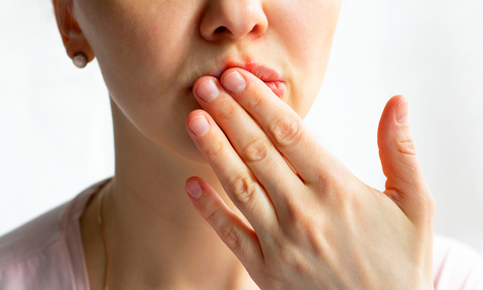 โรคเริม อาการ สาเหตุ การรักษา