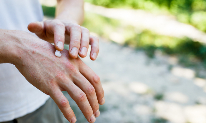 ยาทาแก้คัน ผิวหนังอักเสบ ชนิดต่าง ๆ