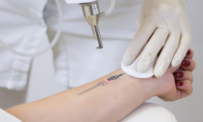 ลบรอยสัก ทำได้อย่างไร มีอันตรายอะไรบ้าง