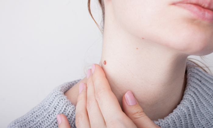 ติ่งเนื้อ อาการ สาเหตุและการรักษา