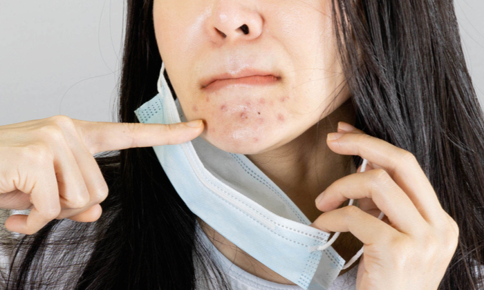 สิวอุดตันหัวปิด สาเหตุ และวิธีรักษา