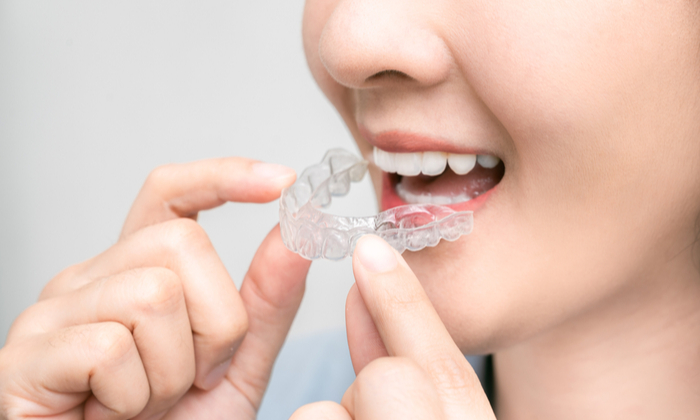 รีเทนเนอร์ ประเภท และวิธีการดูแลรักษา