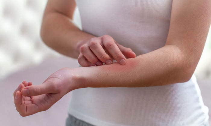 ผื่นกุหลาบ อาการ สาเหตุ และการรักษา