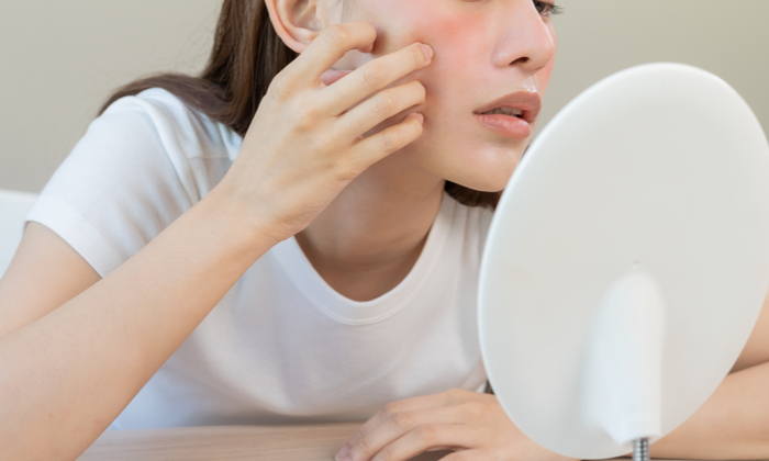 หน้าเป็นผื่น คัน ผิวแสบแดง เกิดจากอะไร รักษาได้หรือไม่