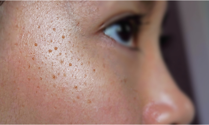 สิวเม็ดข้าวสาร อาการ สาเหตุ การรักษา