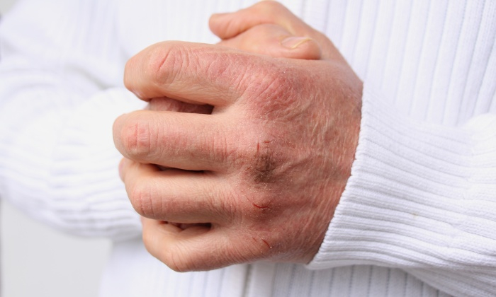 มือชา จากโรคเส้นประสาทที่เกิดจากเบาหวาน