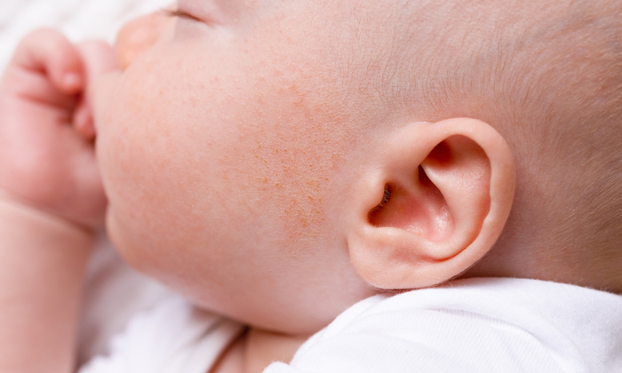 7 สาเหตุที่ทำให้ ลูกเป็นผื่นที่หน้า