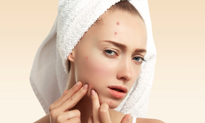 หลุมสิว สาเหตุและทางเลือกในการรักษา