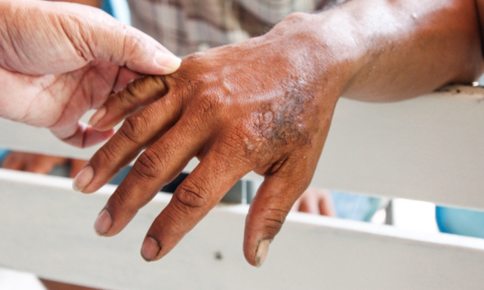 โรคเรื้อน สาเหตุ และวิธีการรักษา