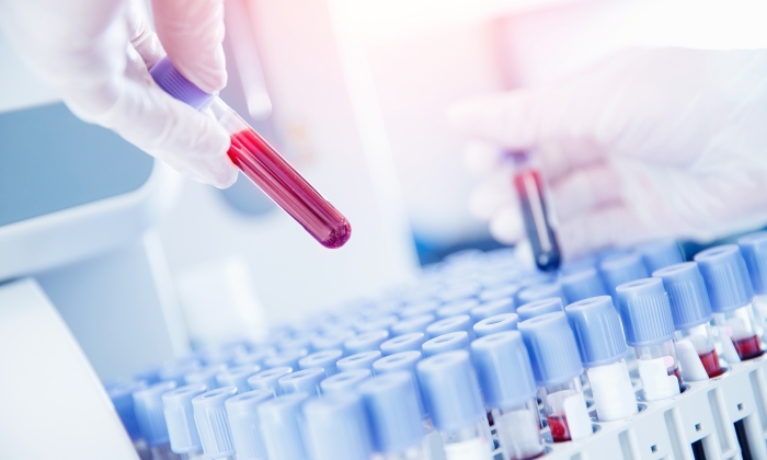 HbA1c คืออะไร เกี่ยวข้องอย่างไรกับเบาหวาน