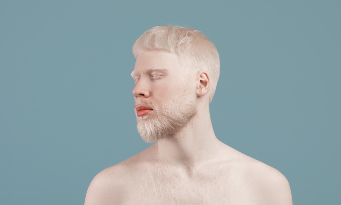 คนผิวเผือก โรคทางพันธุกรรมกับวิธีการดูแลตัวเอง