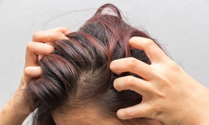 คันหนังศีรษะ สาเหตุและวิธีรักษา