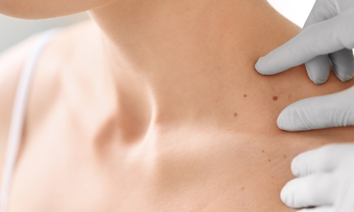 ขี้แมลงวันเกิดจากอะไร เป็นอันตรายต่อสุขภาพผิวหนังหรือไม่