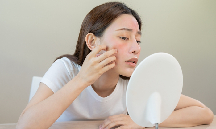 วิธีลดรอยแดงจากสิว มีอะไรบ้าง