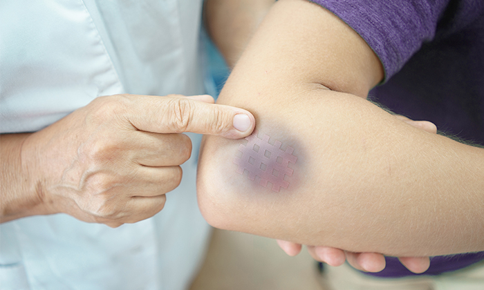 ห้อเลือด ส่งผลต่อสุขภาพผิวอย่างไร