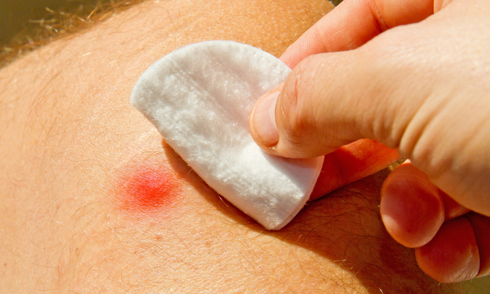 ต่อ แมลง กัดต่อย รักษาได้อย่างไร