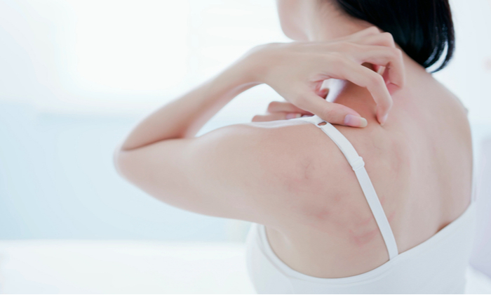 ผื่นแพ้ยา เป็นอย่างไร มีอาการและวิธีการรักษาอย่างไร