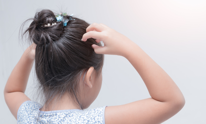 วิธีรักษาเหา ที่ได้ผล มีกี่วิธี ทำอย่างไรบ้าง