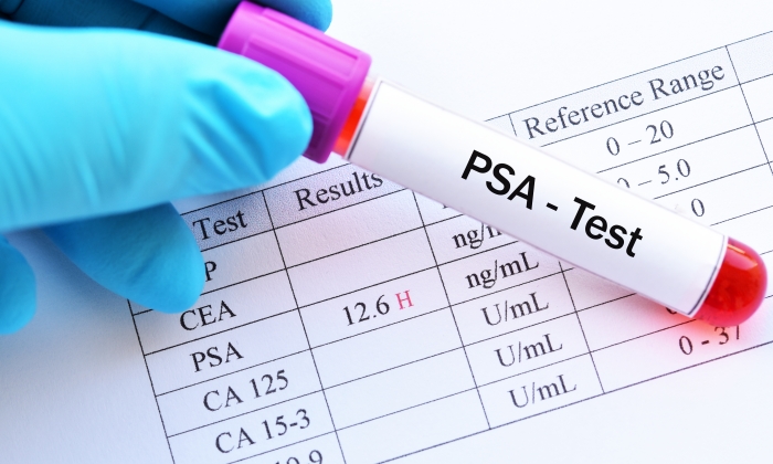 ค่า psa คืออะไร เกี่ยวข้องอย่างไรกับมะเร็งต่อมลูกหมาก