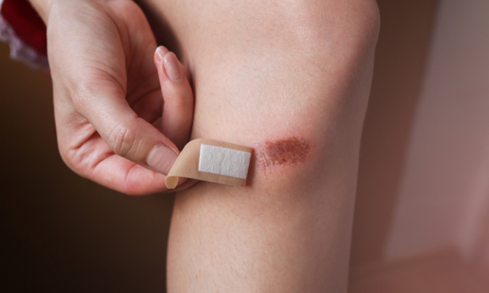 แผลถลอก รักษายังไงให้หายอย่างรวดเร็ว