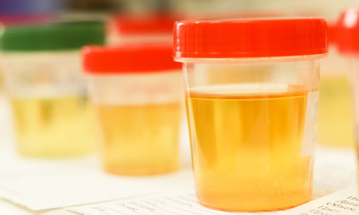 ลักษณะฉี่ของคนเป็นเบาหวาน กลิ่นและสีแตกต่างจากคนปกติอย่างไร