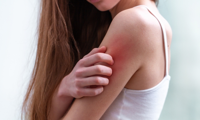 ผื่นแพ้ มีสาเหตุจากอะไร เกี่ยวข้องกับโรคผิวหนังชนิดใดบ้าง