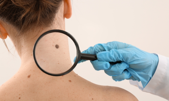 ไฝเกิดจากอะไร อันตรายหรือไม่ สามารถเป็นมะเร็งผิวหนังได้หรือไม่