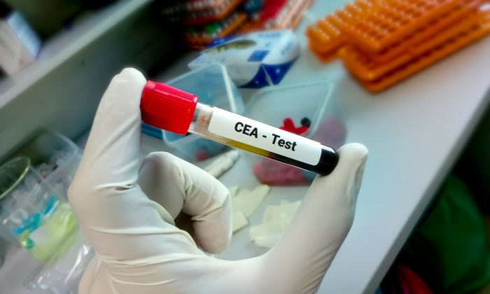 CEA คือ อะไร มีความสำคัญและเกี่ยวข้องอย่างไรกับโรคมะเร็ง
