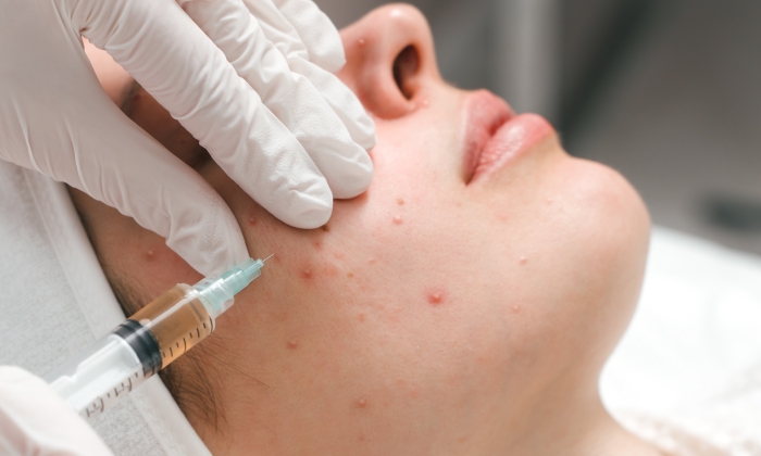 ฉีดสิว เหมาะกับใคร  มีข้อดีและข้อเสียอย่างไรบ้าง