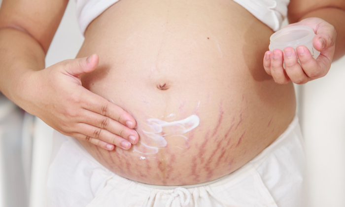 รอยแตกลาย สาเหตุและการรักษา