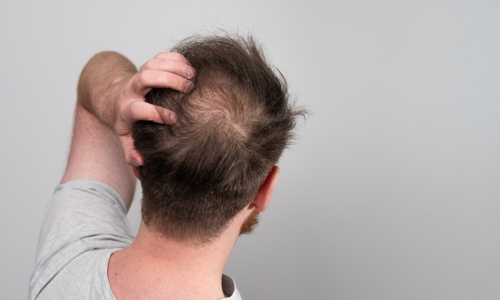 หนังศีรษะเป็นเชื้อรา สาเหตุ การรักษา และป้องกัน