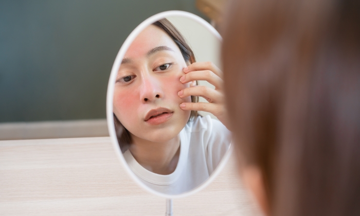 ผดขึ้นหน้า อาการ สาเหตุ  และวิธีรักษา